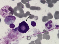 Mast cell in bone marrow