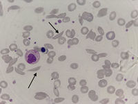Sickle cells (drepanocytes)