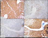 Lymphoplasmacytic lymphoma - IHC
