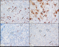 Classical Hodgkin lymphoma - IHC 2