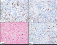 Classical Hodgkin lymphoma - IHC