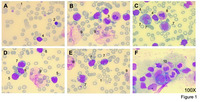 Mixed phenotype acute leukemia in thalassodrepanocytosis