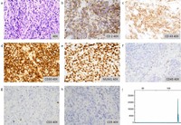 Primary CNS T cell lymphoma: CD2+, CD30+, MUM-1+, CD3-, CD5-, CD7-, CD45-