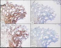 Chronic lymphocytic leukemia