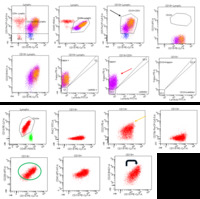 Chronic lymphocytic leukemia - Flow cytometry