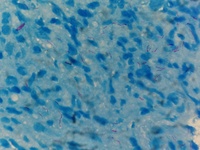 Zeihl Neelson stain with many acid fast bacilli