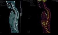 PET CT marrow lesions