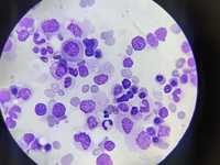 Polycythemia Vera (Bone Marrow Aspirate) with secondary Iron deficiency