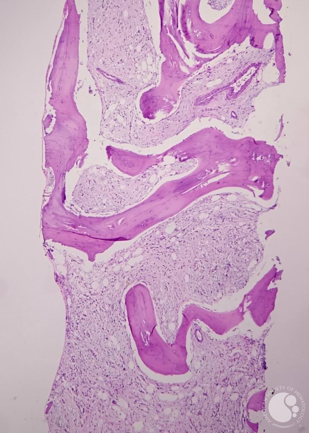 Bone marrow biopsy showing dense fibrosis
