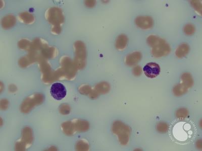 Bluish background staining in multiple myeloma peripheral blood film 2
