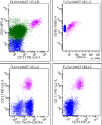 Acute Myeloid Leukemia with Atypical Mast Cells Post-induction