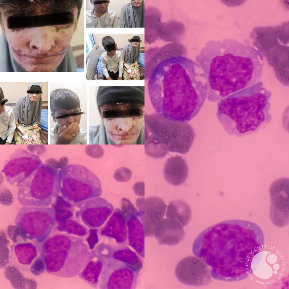 Xeroderma pigmentosum and acute myeloid leukemia: a case report