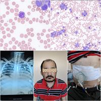 Chronic Myeloid Leukemia with Sanjad Sakati syndrome