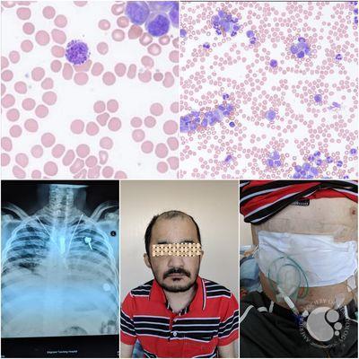 Chronic Myeloid Leukemia with Sanjad Sakati syndrome