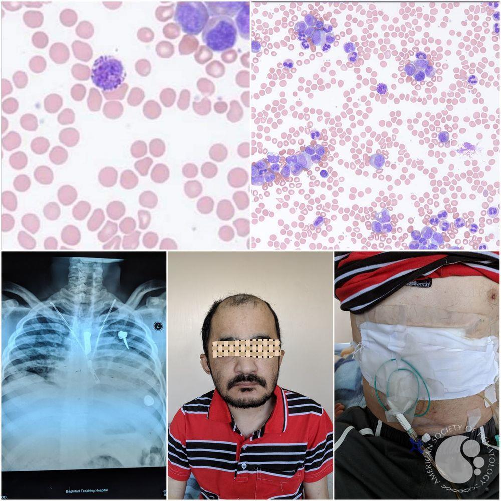 Chronic Myeloid Leukemia with Sanjad Sakati syndrome