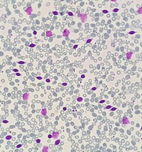 Splenic Marginal Zone Lymphoma