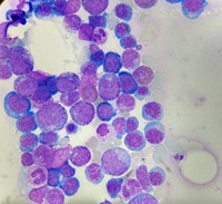 Bone Marrow in Paroxysmal Nocturnal Hemoglobinuria