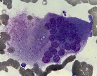 Giant Osteoclast