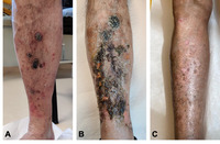 Primary cutaneous CD8+ epidermotropic cytotoxic T-cell lymphomas, a rare and dramatic challenge still open