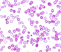 https://imagebank.hematology.org/getimagebyid/63846?size=2