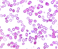 https://imagebank.hematology.org/getimagebyid/63846?size=2