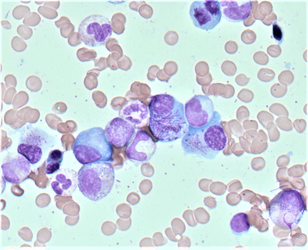 Pseudo-Auer rods in a myeloma patient 1