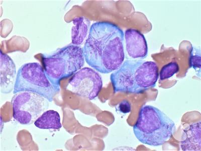 Pseudo-Auer rods in a myeloma patient 2