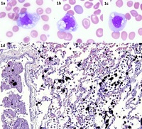 Lipid-laden Monocytes in Peripheral Blood of a Patient with Hemoglobin SC Disease in Crisis
