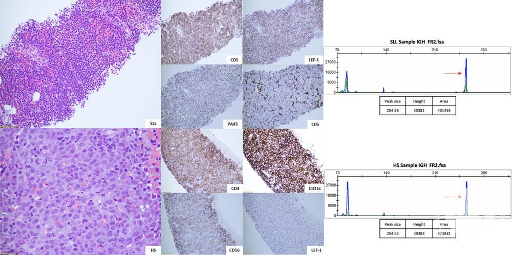 Small lymphocytic lymphoma with trans-differentiation into Histiocytic sarcoma