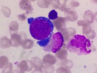 giant proerythroblast with cytoplasmic pseudopodia