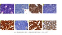 A case of B acute lymphoblastic leukemia/lymphoma with unusual immunophenotypes