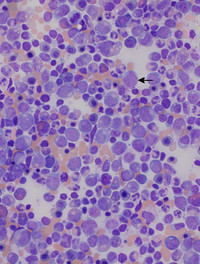 Bone Marrow Aspirate at low power