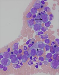 Bone Marrow Aspirate at high power