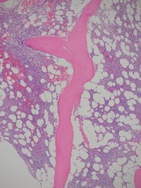 Bone marrow biopsy at low power