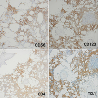 Marrow biopsy Immunohistochemistry