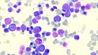 MDS with multilineage dysplasia