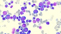 Acute Myeloid Leukemia With Multilineage Dysplasia Not Having Achieved Remission Icd 10