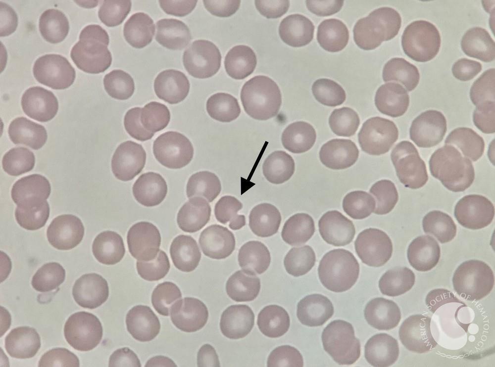 Mushroom- shaped red blood cell