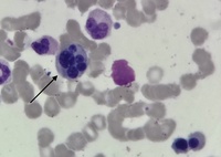 Multinucleated erythroblast