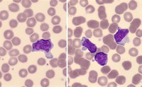 atypical lymphocyte ebv