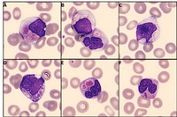 Pseudo Chediak Higashi Granules in Acute Promyelocytic Leukemia