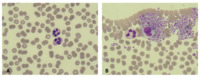 EDTA-dependent pseudothrombocytopenia