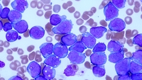 AML with t(8;21) and NRAS mutation