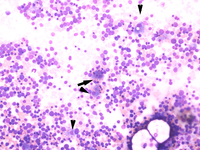 Figure a. Bone marrow aspirate smear, 20X, Giemsa stain showing blasts with Gaucher like cells
