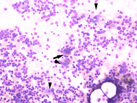 Figure a. Bone marrow aspirate smear, 20X, Giemsa stain showing blasts ...