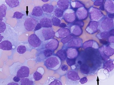 Figure b. Bone marrow aspirate smear, 100X, Giemsa stain showing blasts with Auer rods and Gaucher like cells