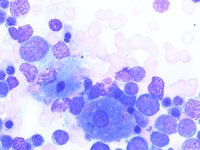 Figure c. Bone marrow aspirate smear 100X, Giemsa stain showing Gaucher like cell in AML.