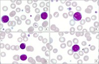 Alder Reilly Anomaly Morphologic Clue In A Patient With Hunter Syndrome 8888