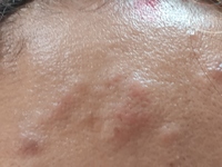 BLEOMYCIN INDUCED FLAGELLATE DERMATITIS 3