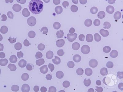Leishman stain 100 X; Bite cells, Blister cells and toxic granulation in neutrophil